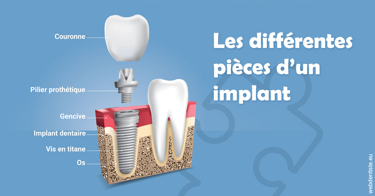 https://lavilla-aix.fr/Les différentes pièces d’un implant 1
